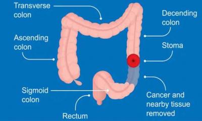 Cancer of the rectum